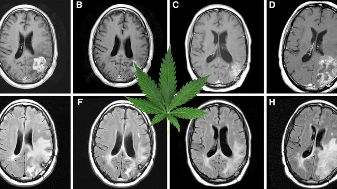 Grid of brain MRI scans in black and white with a green cannabis leaf overlaid at the center, symbolizing research or discussion of cannabis and neurological or brain conditions.